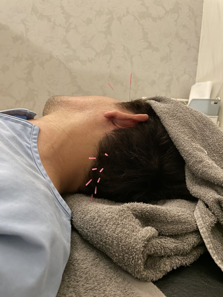 中心性網膜症鍼治療