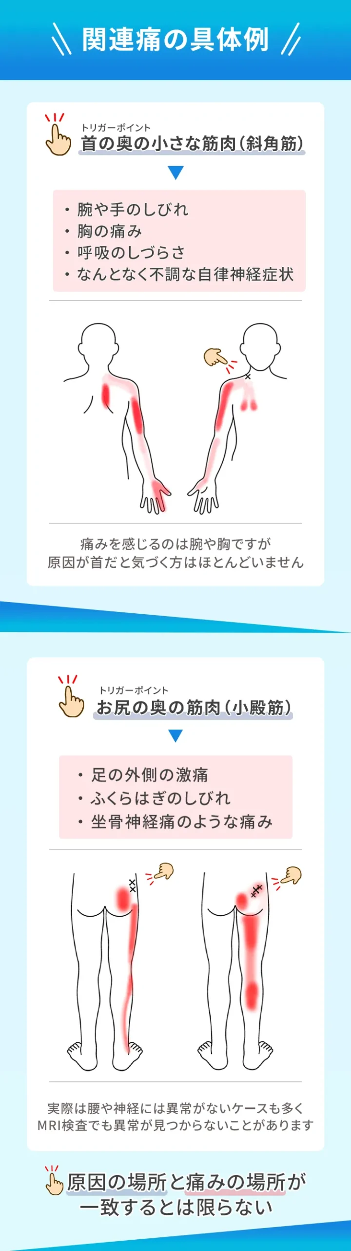 首の奥にある小さな筋肉にトリガーポイントができると、「腕」や「胸」に痛みや不快感を感じます。 お尻の奥にある筋肉です。 ここに異常があると、 ・足の外側の激痛 ・ふくらはぎのしびれ ・坐骨神経痛のような痛み が出ることがあります。