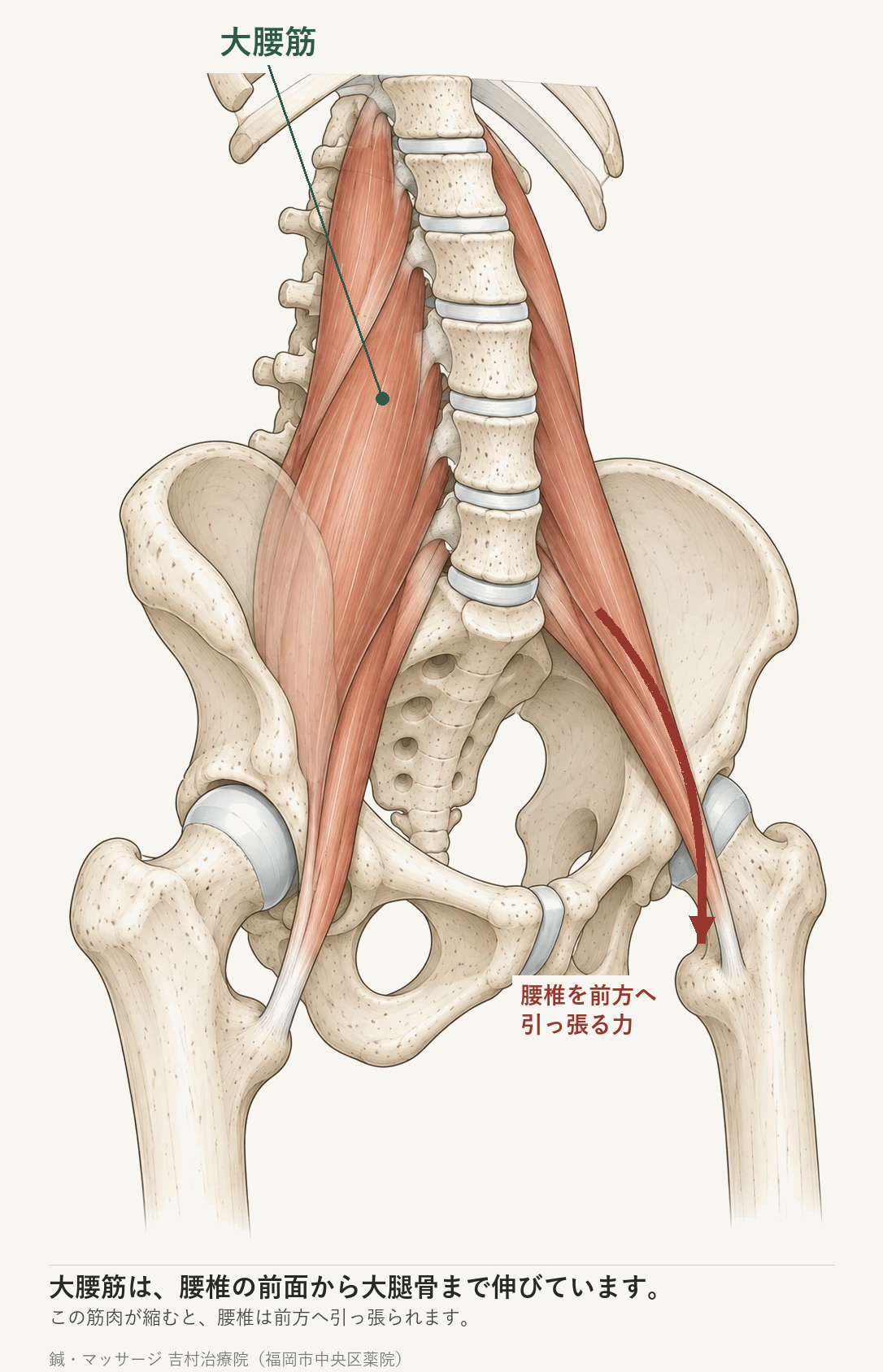大腰筋が腰椎の前面から大腿骨につながっている様子を示した図。大腰筋が腰椎を前方へ引っ張る力の向きを矢印で示している。
