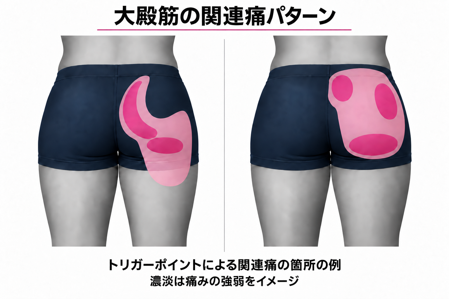 大殿筋の関連痛パターン