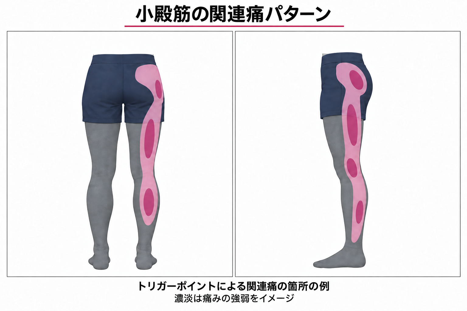 小殿筋の関連痛パターン